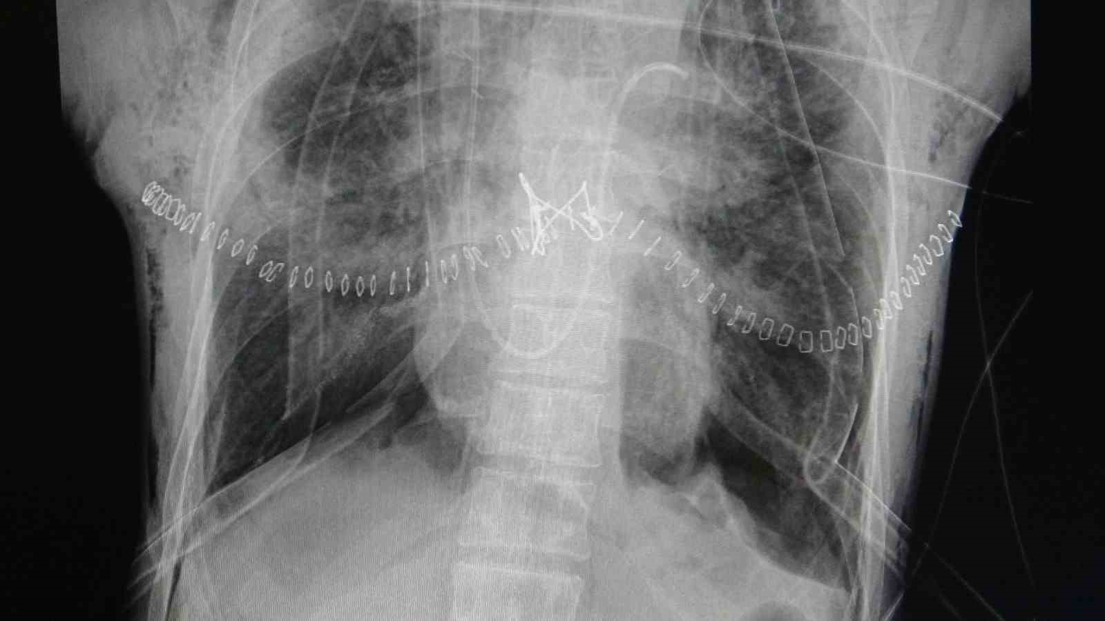 Organ Naklinin Önemi ve Toplumdaki Duyarlılık