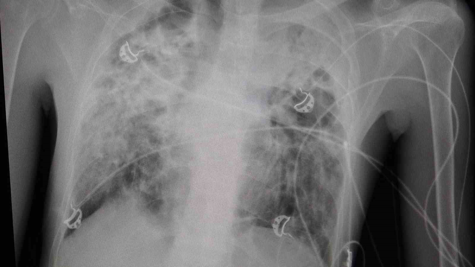 Organ Bağışının Toplumda Artması ve İnsanlara Umut Olması