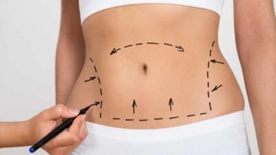Karın Germe Ameliyatı Rehber Nedir? Nasıl yapılır? Karın germe ameliyatı