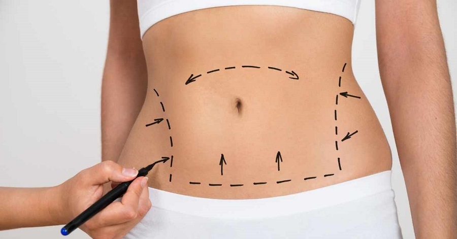 Karın Germe Ameliyatı Rehber Nedir? Nasıl yapılır? Karın germe ameliyatı