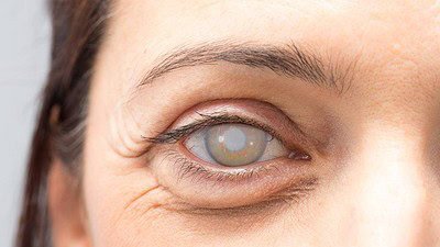 Tavuk Karası Hastalığı nedir, belirtileri ve tedavi yöntemleri hakkında kolay